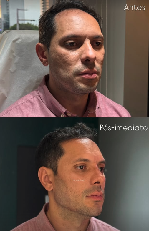 Harmonização masculina · pós-imediato