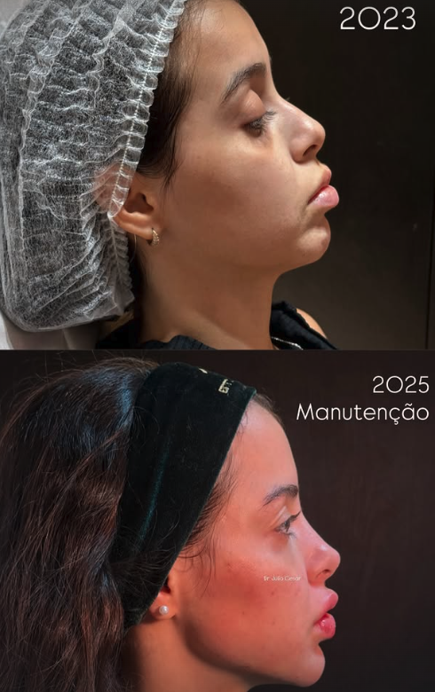 Harmonização facial · manutenção 2 anos